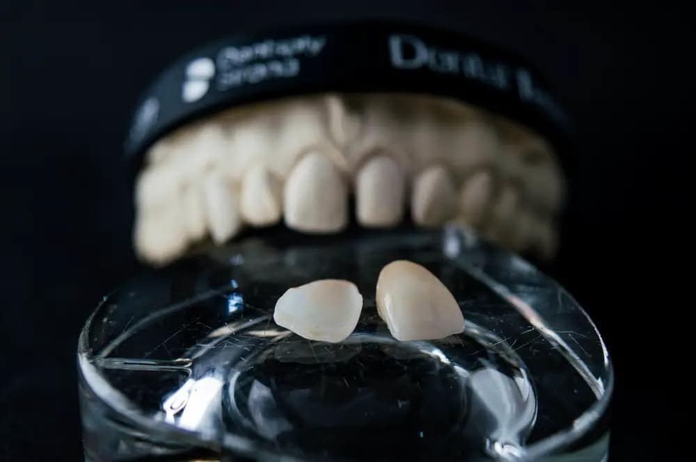 failed composite veneers