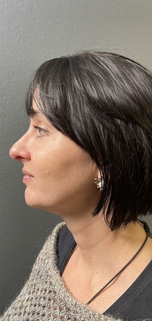 Dr Zak Aesthetics Before 3