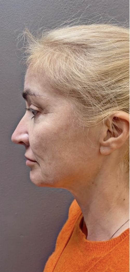 Dr Zak Aesthetics Before 1